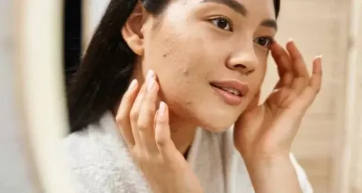 Akne Bakımı