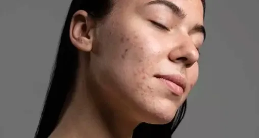 Akne Bakımında Yenilikler: Etkili Çözümler Nelerdir?
